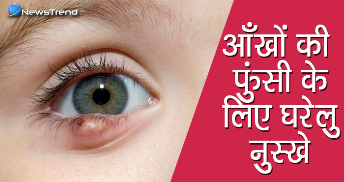 आंखों की फुंसी से निजात दिलाते हैं ये घरेलु उपाय, आजमाकर देखिए