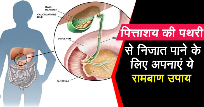 पित्ताशय में पथरी की समस्या से परेशान हैं तो अपनाएँ ये घरेलू उपाय, जल्द मिलेगी राहत