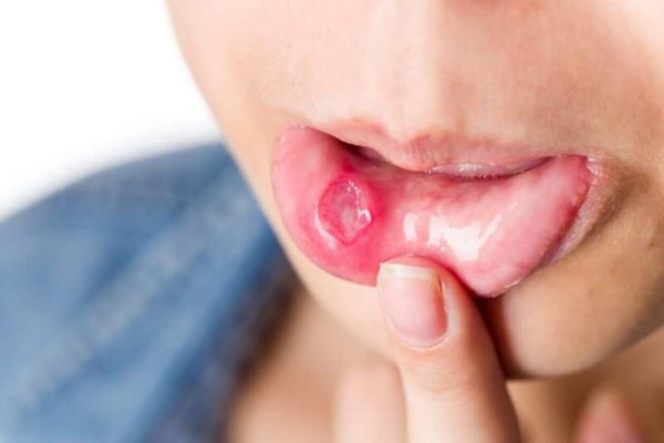 मुंह के छाले : कटहल खाने के फायदे 