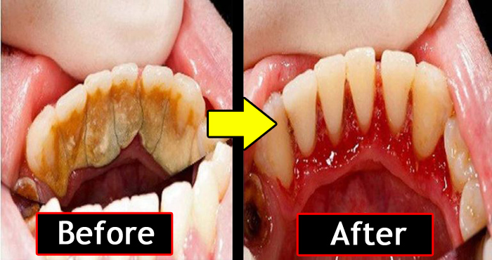 13 चीजों के इस्तेमाल से चुटकी में निकाल सकते हैं आप दांतों पर ज़मी मैल, जानिए कैसे?
