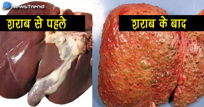 शराब पीने के तुरंत बाद ऐसा हो जाता है लीवर का हाल, देखकर आज ही दारू से कर लेंगे तौबा