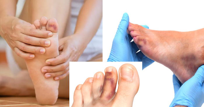 डॉक्टर की चेतावनी: यदि आपके पैरों में भी हैं ऐसे निशान तो हो सकता हैं कोरोना