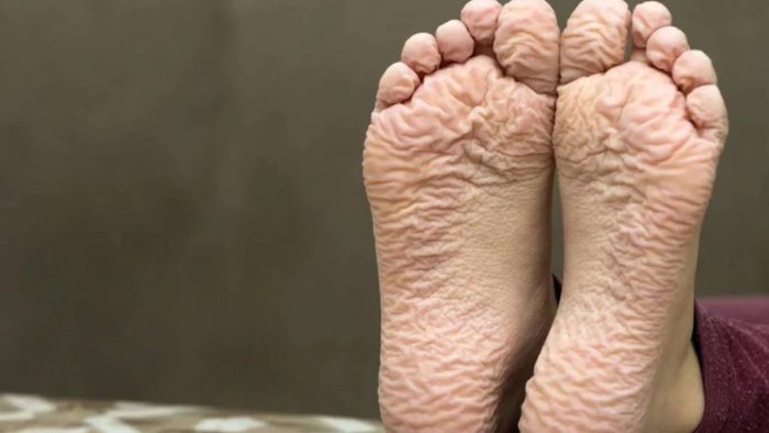 Trench Foot wrinkles
