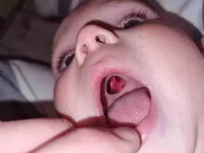 hole inside baby mouth