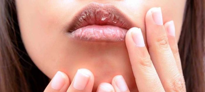 dry lips