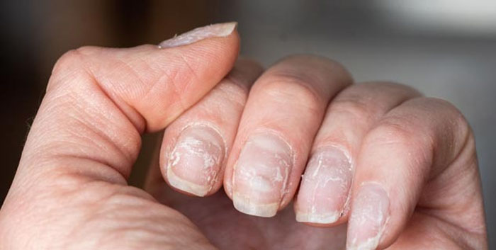 nail diseases