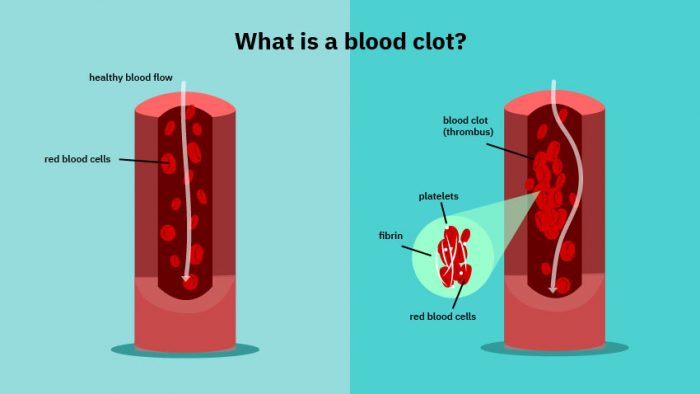 blood cloting