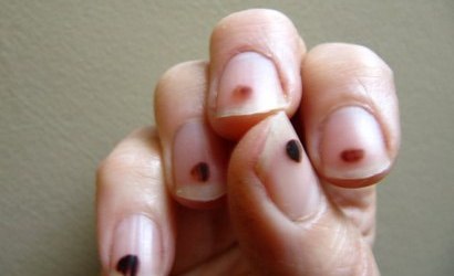 nail disease 