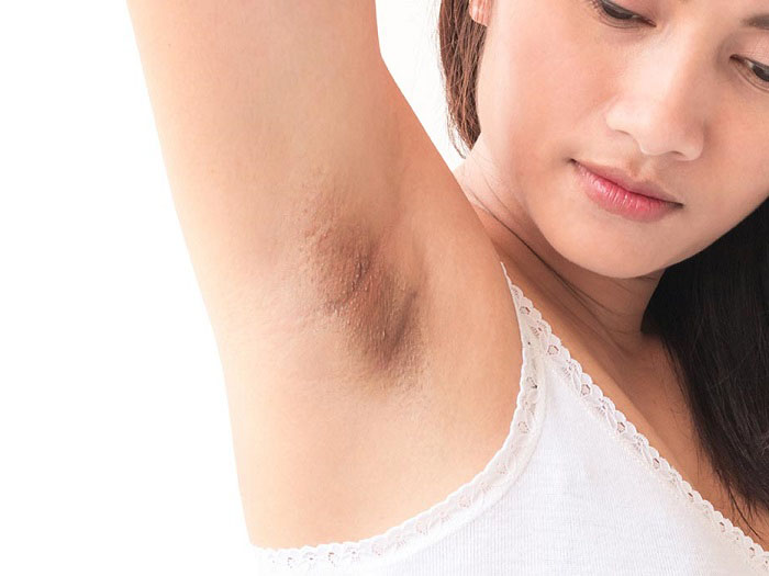 underarms