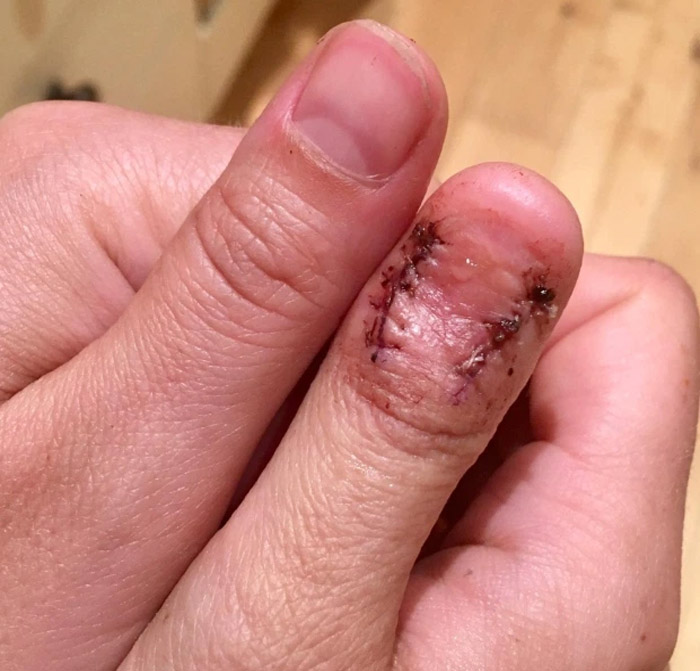 nail disease 