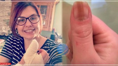 women-ignored-mark-on-finger-nail-for-years-discovers-rare-deadly-cancer