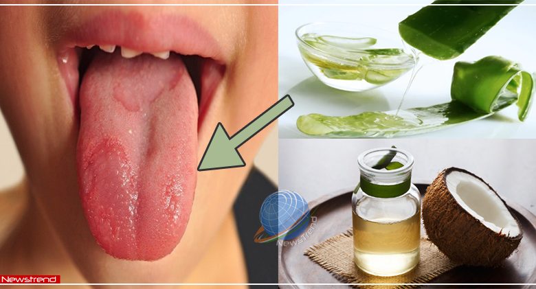 tongue ulcer home remedy