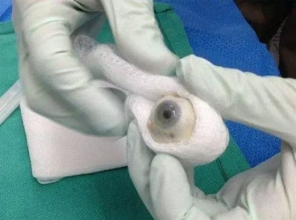 eye donor