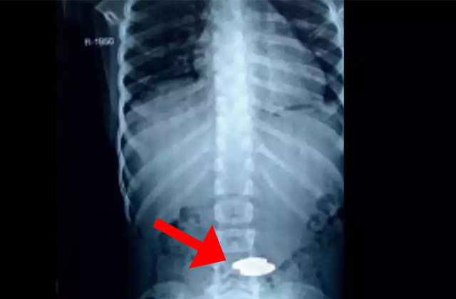 madhya pradesh magnet stomach 3 year old child