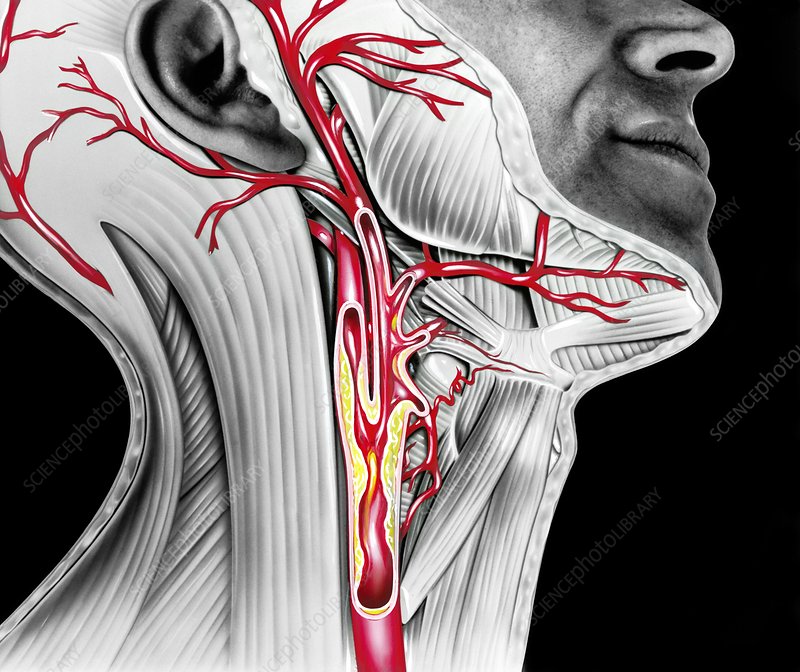 Carotid