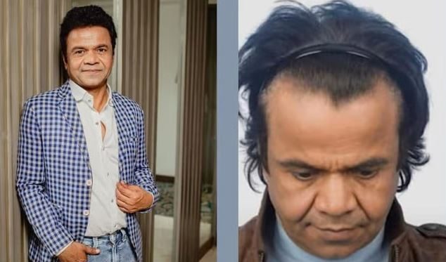 rajpal yadav hair transplant